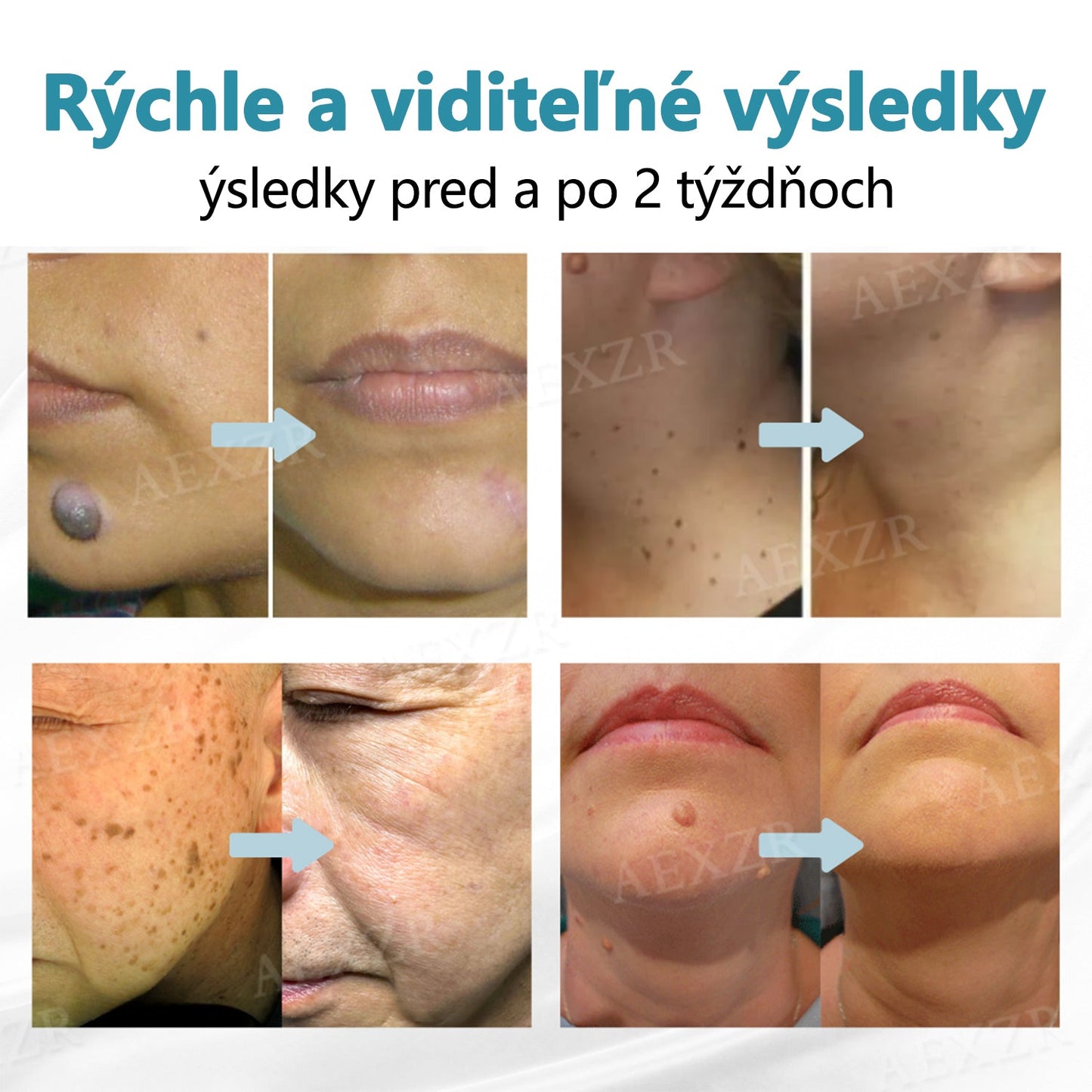 Bikenda® Neinvazívne laserové pero na odstránenie znamienok a bradavíc🔦