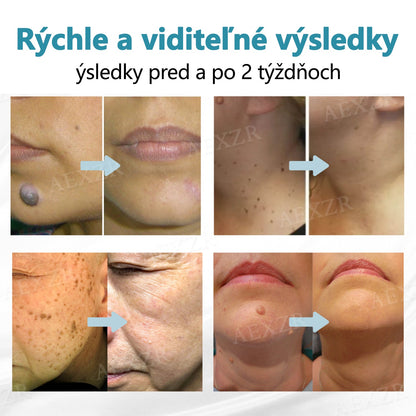 Bikenda® Neinvazívne laserové pero na odstránenie znamienok a bradavíc🔦