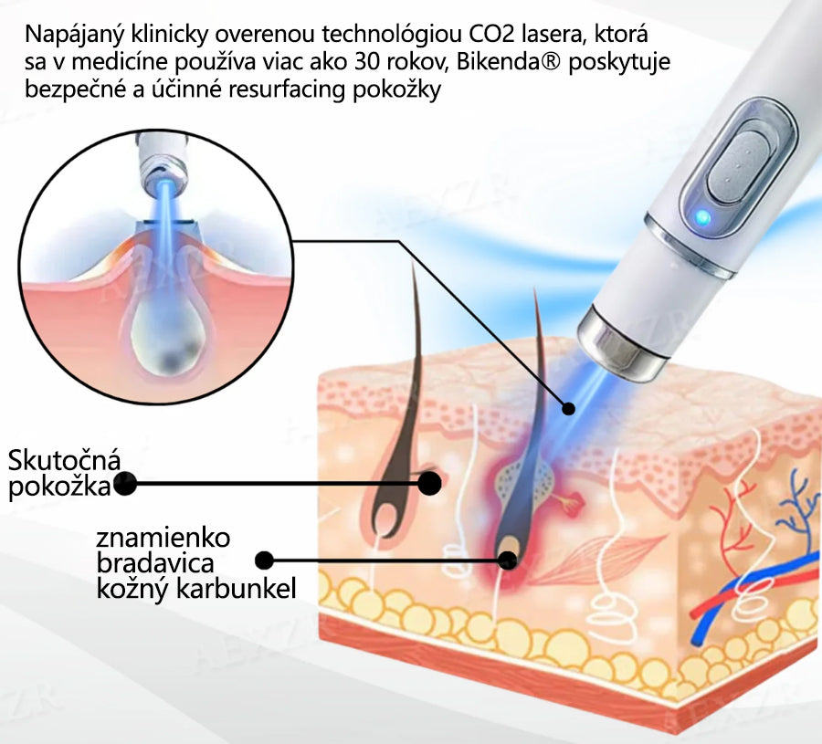 Bikenda® Neinvazívne laserové pero na odstránenie znamienok a bradavíc🔦